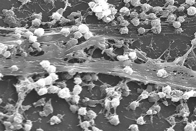 Staphylococcus aureus biofilm (living film that slime layers help to make sticky) on an indwelling catheter.